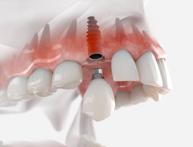 Dental Implants